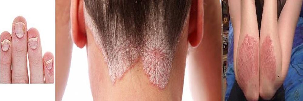 psorijaza